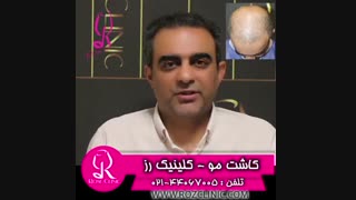 فیلم کاشت مو | کلینیک رز | 02144067005 | شماره 71