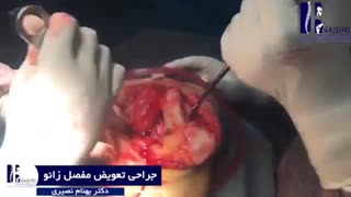 جراحی بدون سانسور تعویض مفصل زانو