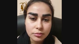 جراحی پلک فوقانی