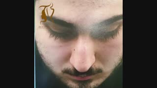 فیلم جراحی انحراف بینی