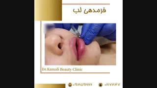 فرمدهی لب با ژل