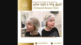 تزریق چانه و زاویه سازی صورت