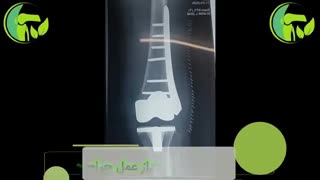 شکستگى تعویض مفصل زانو