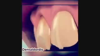 لمینیت دندان و زیبایی در کمترین زمان