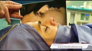 جراحی بینی گوشتی و کج توسط بهترین جراح بینی تهران