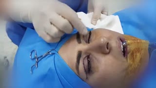 جراحی پلک بالا توسط دکتر شهریار یحیوی