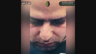 جراحی زیبایی بینی در بیمار با صورت نامتقارن و بینی کج | دکتر باستانی نژاد