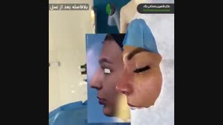 جراحی زیبایی بینی در بینی با پوست ضخیم | دکتر باستانی نژاد