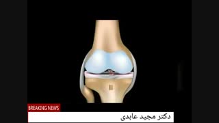 کشیدگی  رباط صلیبی