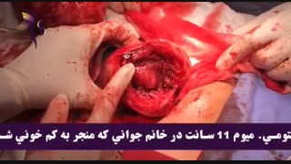 جراحی میومکتومی فیبروم رحم