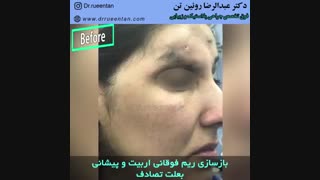 بازسازی ریم فوقانی اربیت و پیشانی بعلت تصادف توسط دکتر عبدالرضا روئین تن فوق تخصص جراحی پلاستیک