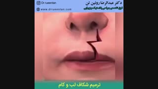 ترمیم شکاف لب و کام | فوق تخصص جراحی پلاستیک | دکتر عبدالرضا روئین تن
