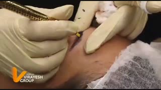 فیبروز ابرو