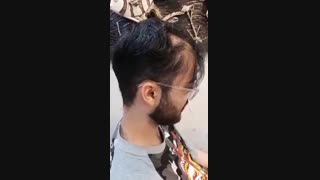 کاشت موی نا موفق به علت سن پایین فرد متقاضی