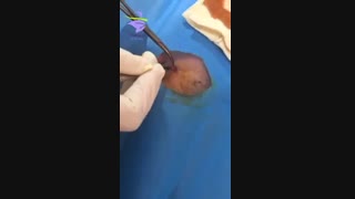 جراحی خال بزرگ