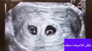 فیلم سونوگرافی جنین دوقلو