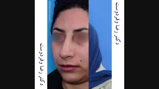 نمونه جراحی بینی طبیعی دو ماه بعد از عمل