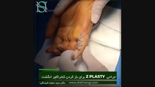 فیلم جراحی z plasty کنتراکچر انگشت