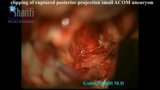 فیلم جراحی آنوریسم مغزی در آقای جوان به دنبال خونریزی