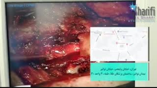 فیلم واقعی جراحی تومور نخاع گردن