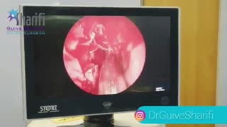 فیلم جراحی مستند و کامل عمل هیپوفیز مغزی (از 0 تا 100)