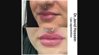 تزریق ژل هیالورونیک اسید