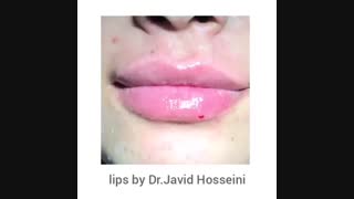 فرم دهی لب با تزریق زل