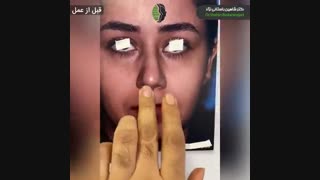 جراحی بینی اولیه در بینی پیچدار و گوشتی | دکتر باستانی نژاد