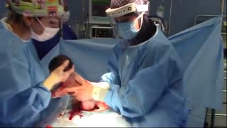 عمل زایمان سزارین