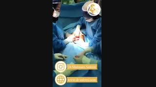 زایمان سزارین چهارقلویی