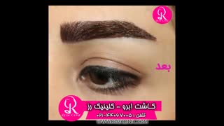 فیلم کاشت ابرو | کلینیک رز | 09104440228 | شماره 202