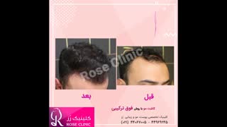 فیلم کاشت مو | کلینیک رز | 09104440228 | شماره 73