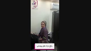 رفع ترک های پوستی کلینیک لیزر