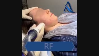آر اف صورت، جهت جوانسازى پوست تزریق ژل