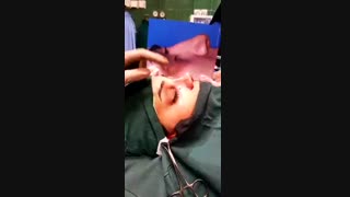 انتهای عمل بینی