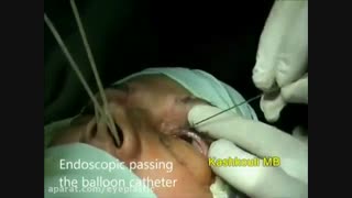 فیلم جراحی آندوسکوپی انسداد مجرای اشکی با بالون | پروفسور کشکولی