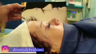 جراحی همزمان لیفت ابرو، اصلاح پف پلک و زیبایی بینی	| بهترین جراح بینی تهران