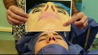 عمل ترمیمی بینی	| دکتر امید ابراهیمی جراح بینی تهران