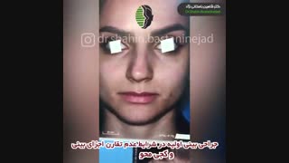 جراحی بینی اولیه با عدم تقارن اجزا و کجی محور بینی | دکتر باستانی نژاد