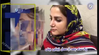 یک ماه بعد از عمل بینی | بهترین جراح بینی دکتر گلی