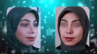 قبل و بعد از جراحی بینی | دکتر یحیوی