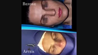 بلافاصله بعد از عمل بینی | دکتر رفیع
