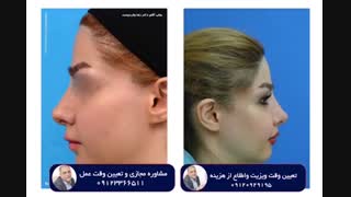 جراحی بینی طبیعی دو ماه بعد از عمل