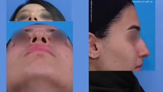 نمونه جراحی بینی طبیعی دو ماه بعد از عمل