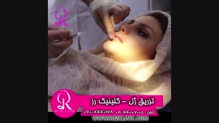 فیلم تزریق ژل | کلینیک رز | 09104440228 | شماره 174