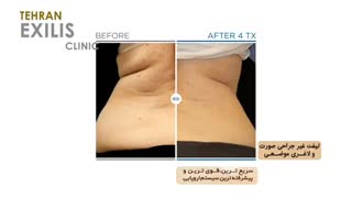 فیلم لیفت غیر جراحی صورت و لاغری موضعی با اگزیلیس کلینیک مو