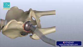 فیلم عمل تعویض مفصل هیپ