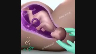 ساختار واژن و قرار گرفتن نوزاد برای زایمان طبیعی در آن