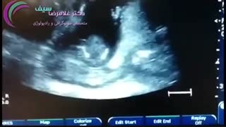 واکنش جنین در شکم مادر