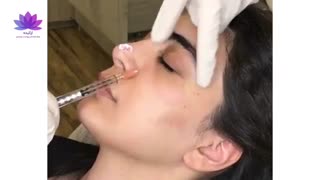 تزریق فیلر در کلینیک ارکیده